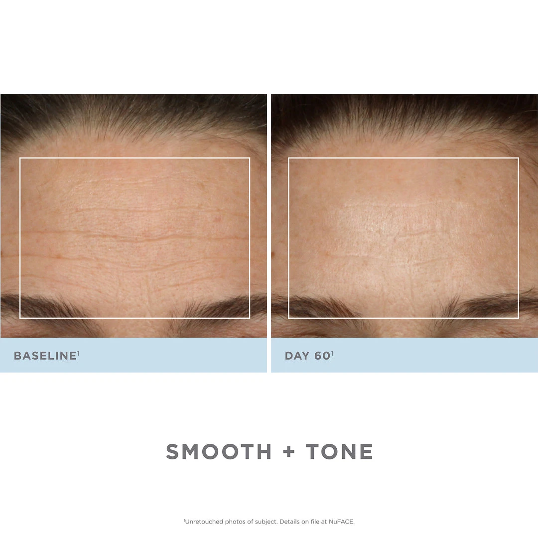 NuFACE Trinity Pro Facial Toning Kit + ELE 6 NuFACE Trinity Pro Facial Toning Kit + ELE